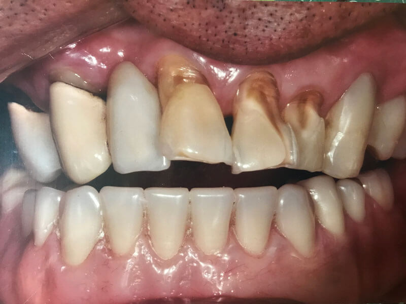 before image of teeth