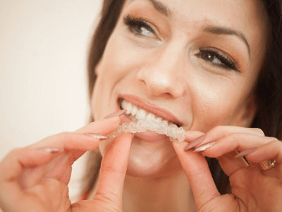 young-woman-inserting-aligners