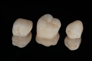 avon dental crown
